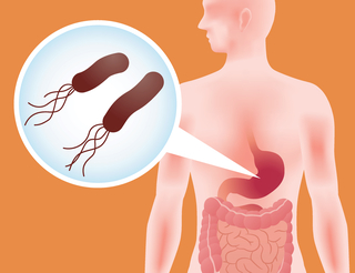 H pylori is a common bug in the human stomach